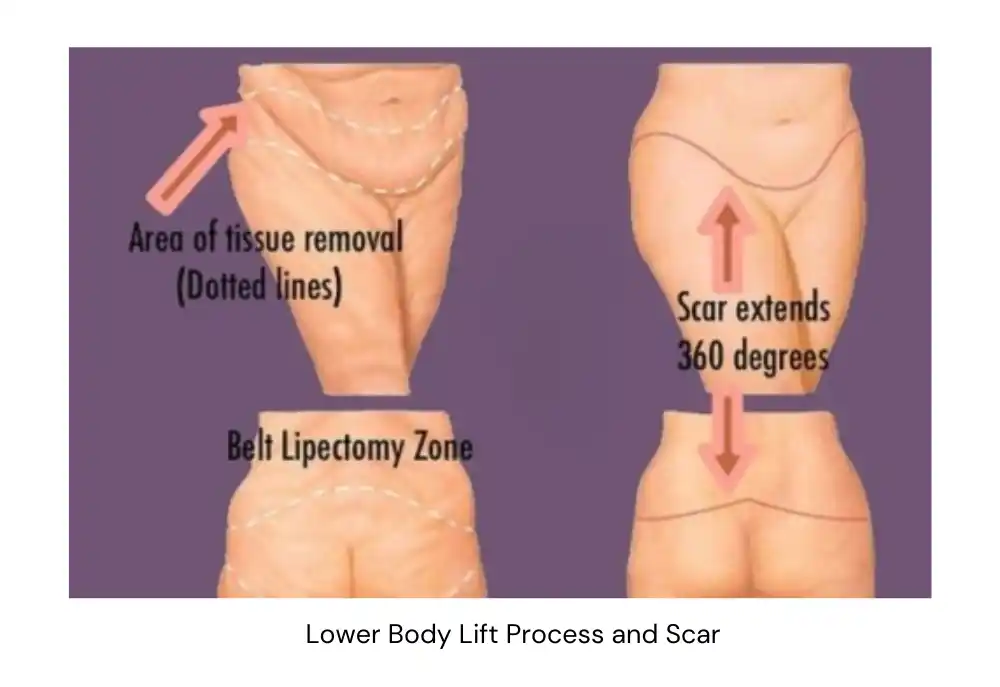 Lower Body Lift Process and scar